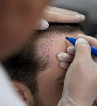 Hair Transplantation