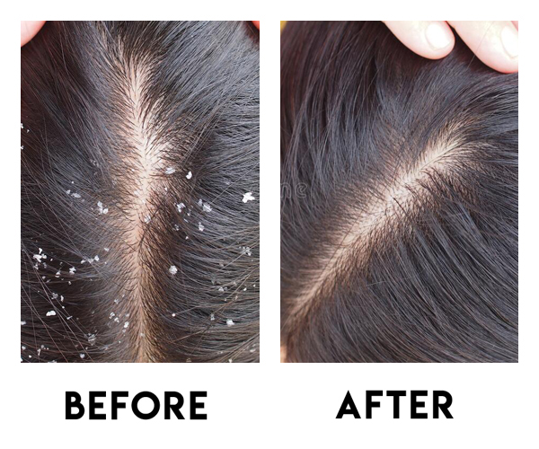Dandruff Treatment