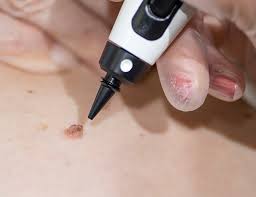 SKIN TAG REMOVAL